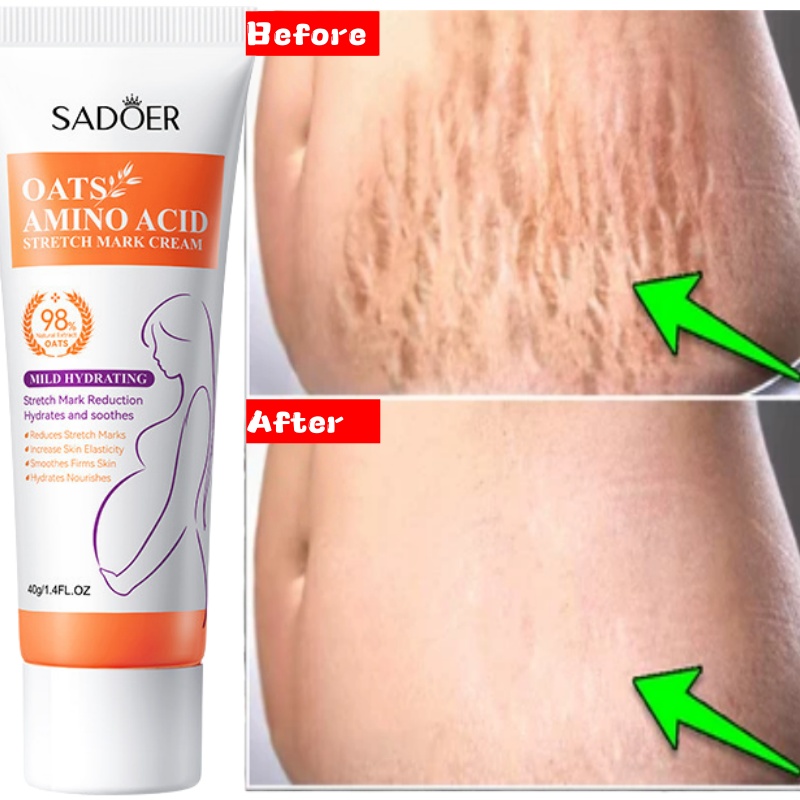 Stretch Marks Permanent Remova - Skincare Oat review and price
