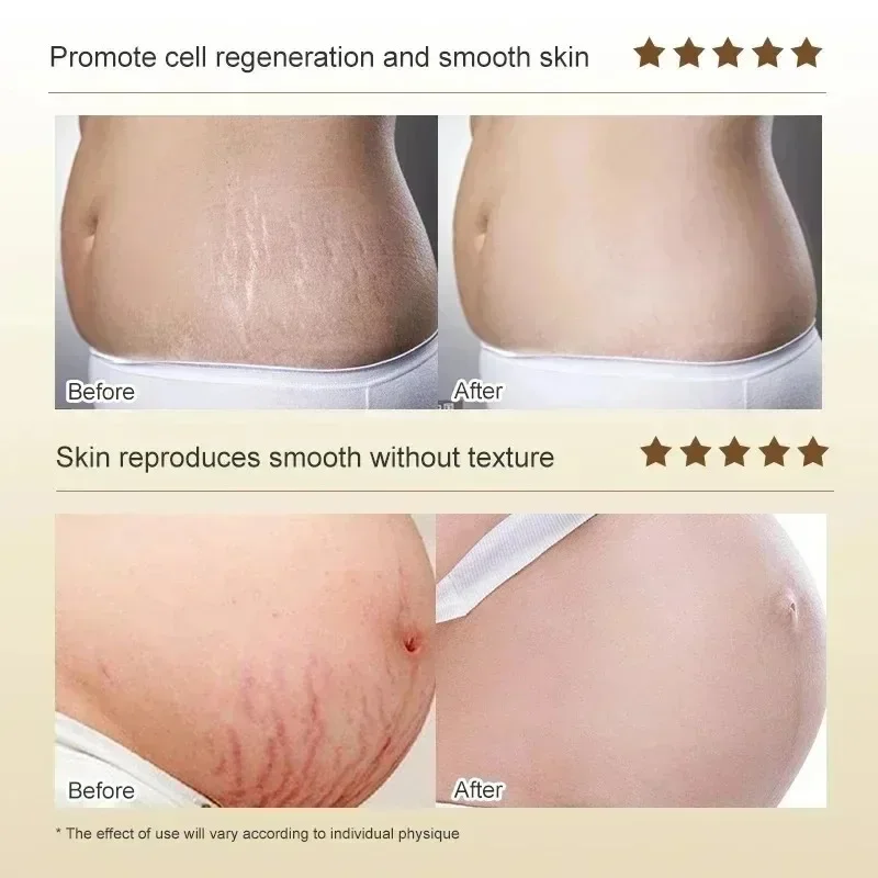 Stretch Marks Permanent Remova - Skincare Oat review and price